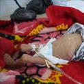 الجوع والكوليرا يقتلان 80% من أطفال اليمن